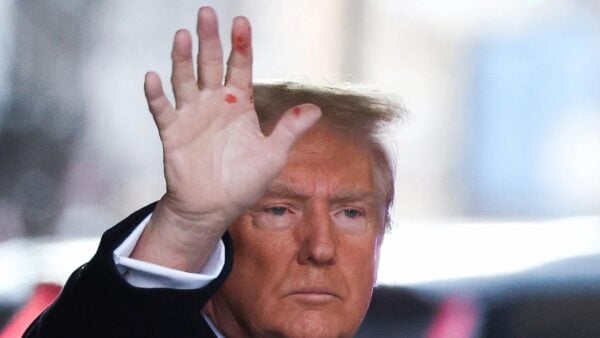 Trump Responds to Rumors About Red Marks on His Hand